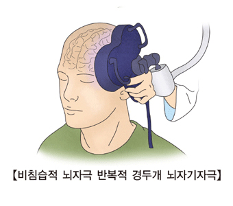 비침습적 뇌자극 반복적 경두개 뇌자기자극 이미지